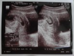 妊娠10週目のエコー画像