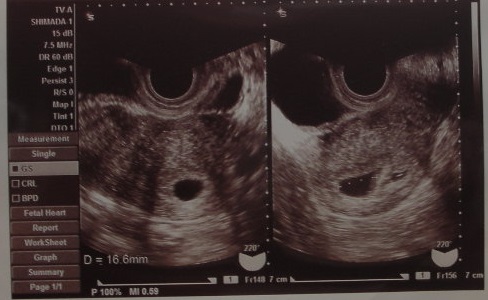 胎のう（GS）エコー画像