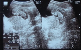 妊娠12週目のエコー画像