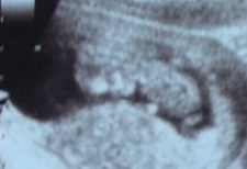 妊娠12週目赤ちゃんエコー画像