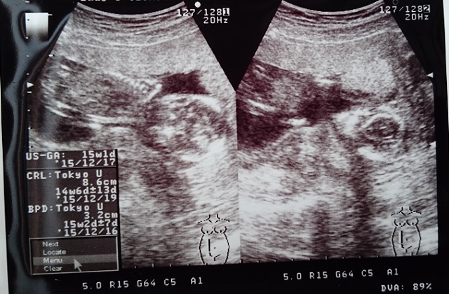 妊娠16週目のエコー画像